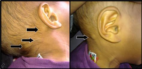 A vesicopustular exanthem has also been described. . Posterior auricular lymph nodes swelling
